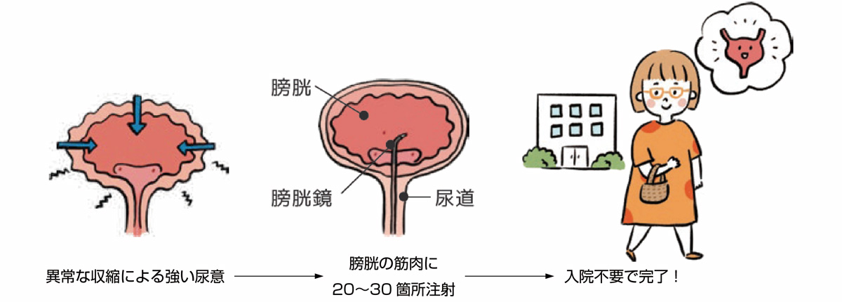 ボツリヌス療法