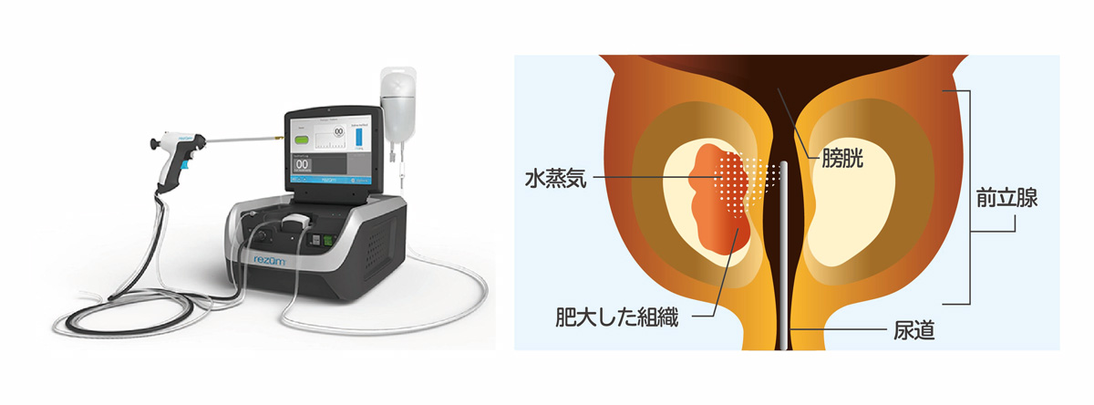前立腺水蒸気治療（WAVE）